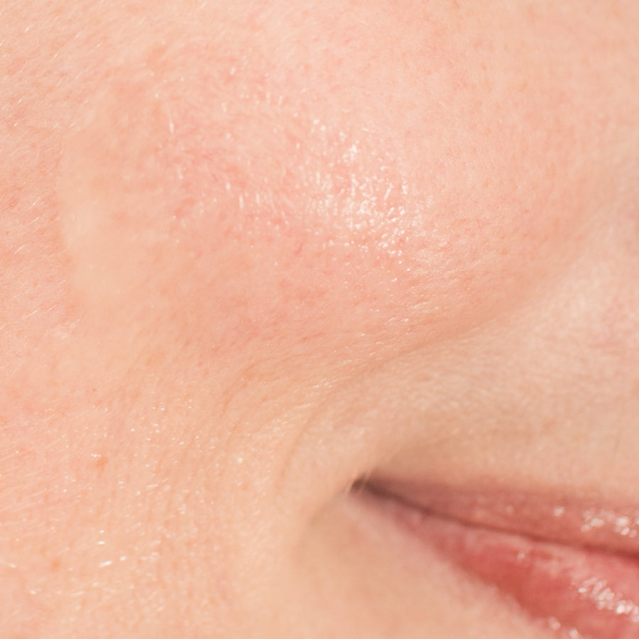 Rosácea, dermatitis o piel reactiva. Cómo distinguirlas y recuperar el equilibrio de la piel.