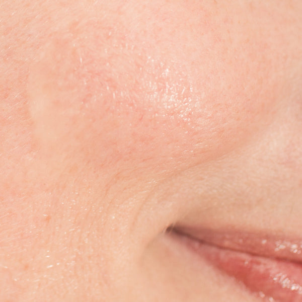 Rosácea, dermatitis o piel reactiva. Cómo distinguirlas y recuperar el equilibrio de la piel.