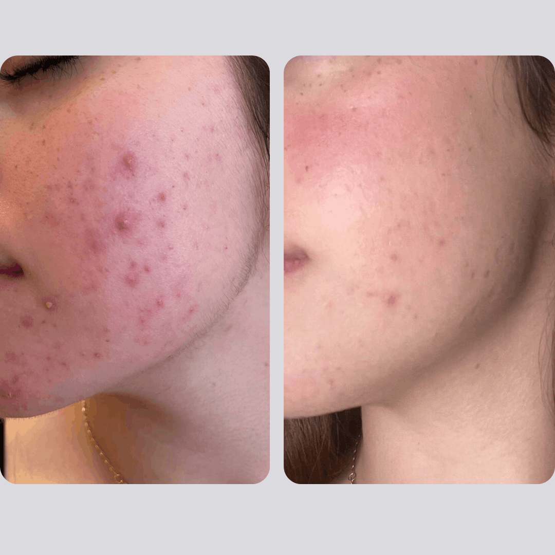 Cuidado de la piel en adolescentes y preadolescentes