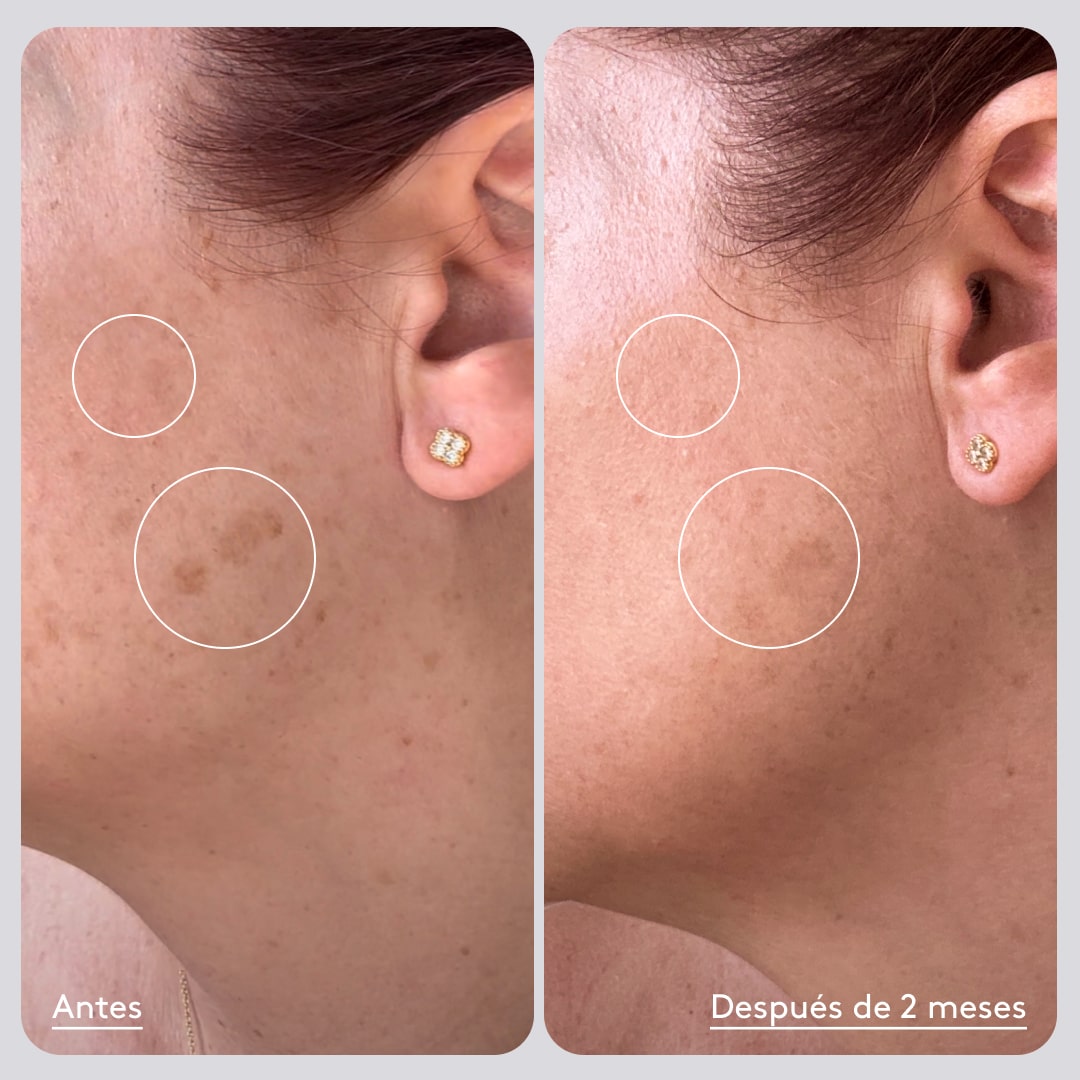 Manchas y verano, ¿por qué se ven más oscuras y cómo difuminarlas?